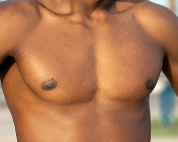 Gynecomastia Surgery